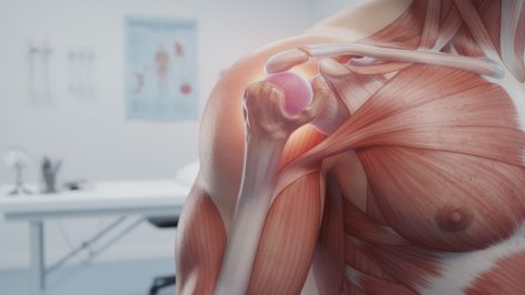 Découvrez les symptômes, les causes et les options de traitement de la capsulite rétractile pour mieux comprendre et gérer cette affection de l'épaule.